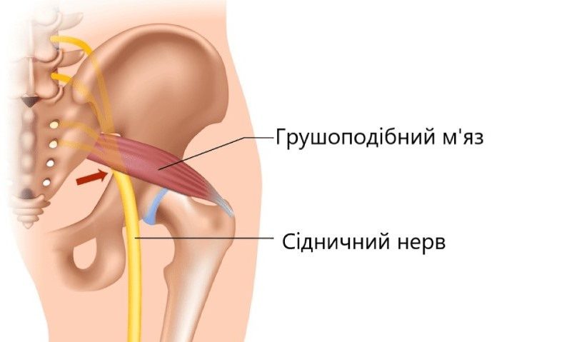 Синдром грушоподібного м’яза